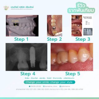 รีวิวรากฟันเทียม