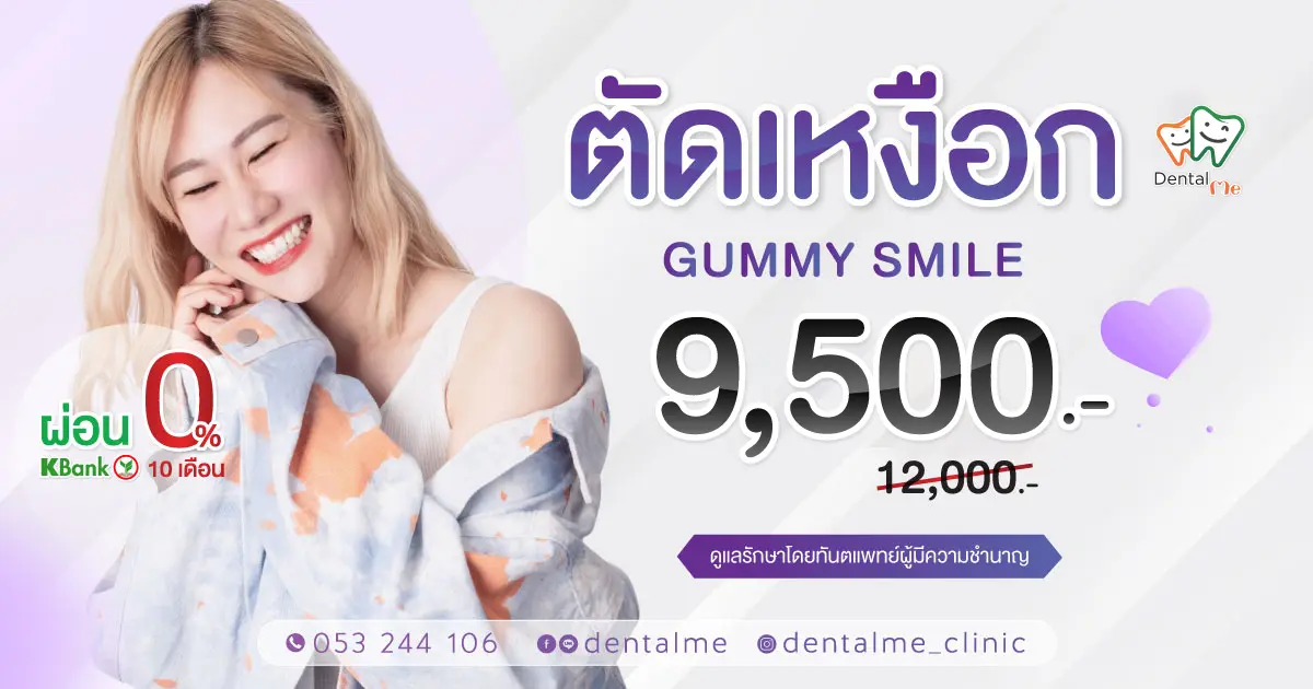 โปรโมชั่นตัดเหงือก Gummy Smile ที่ Dentalme Clinic เชียงใหม่ ราคาพิเศษ 9,500 บาท พร้อมผ่อน 0% 10 เดือน