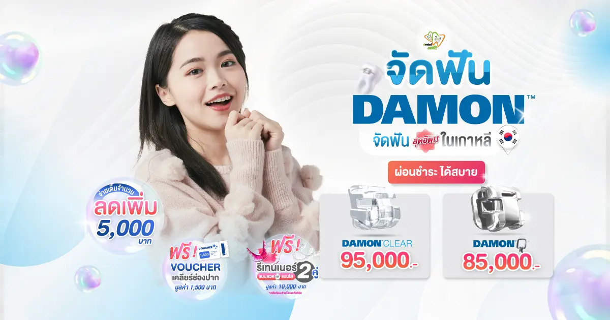 โปรโมชั่นจัดฟัน Damon ที่ Dentalme Clinic เชียงใหม่ ผ่อนชำระสบาย ลดเพิ่ม 5,000 บาท ฟรีรีเทนเนอร์ 2 คู่