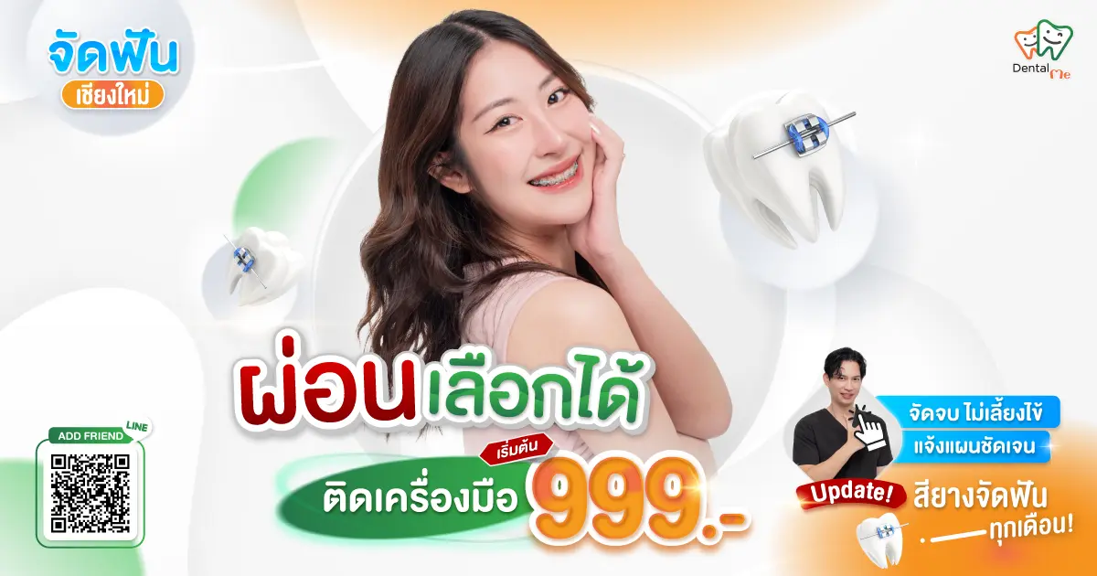 จัดฟันเชียงใหม่ ผ่อนเลือกได้ เริ่มต้น 999 บาท พร้อมโปรโมชั่นพิเศษ