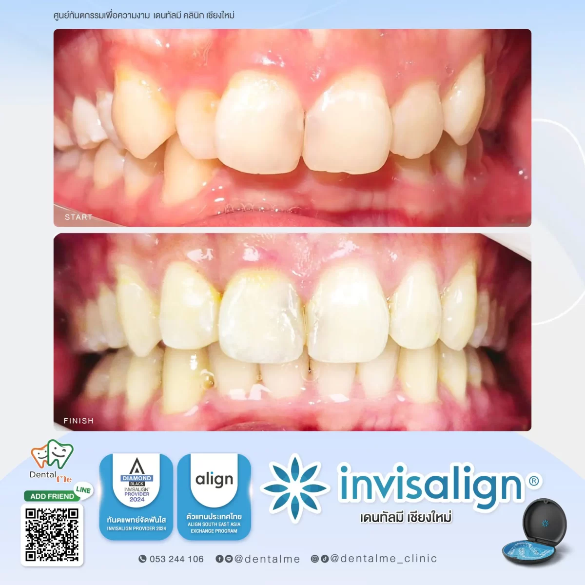 ผลลัพธ์การจัดฟันใส Invisalign เคสฟันซ้อนเก การเปลี่ยนแปลงก่อนและหลังที่ Dentalme คลินิก เชียงใหม่