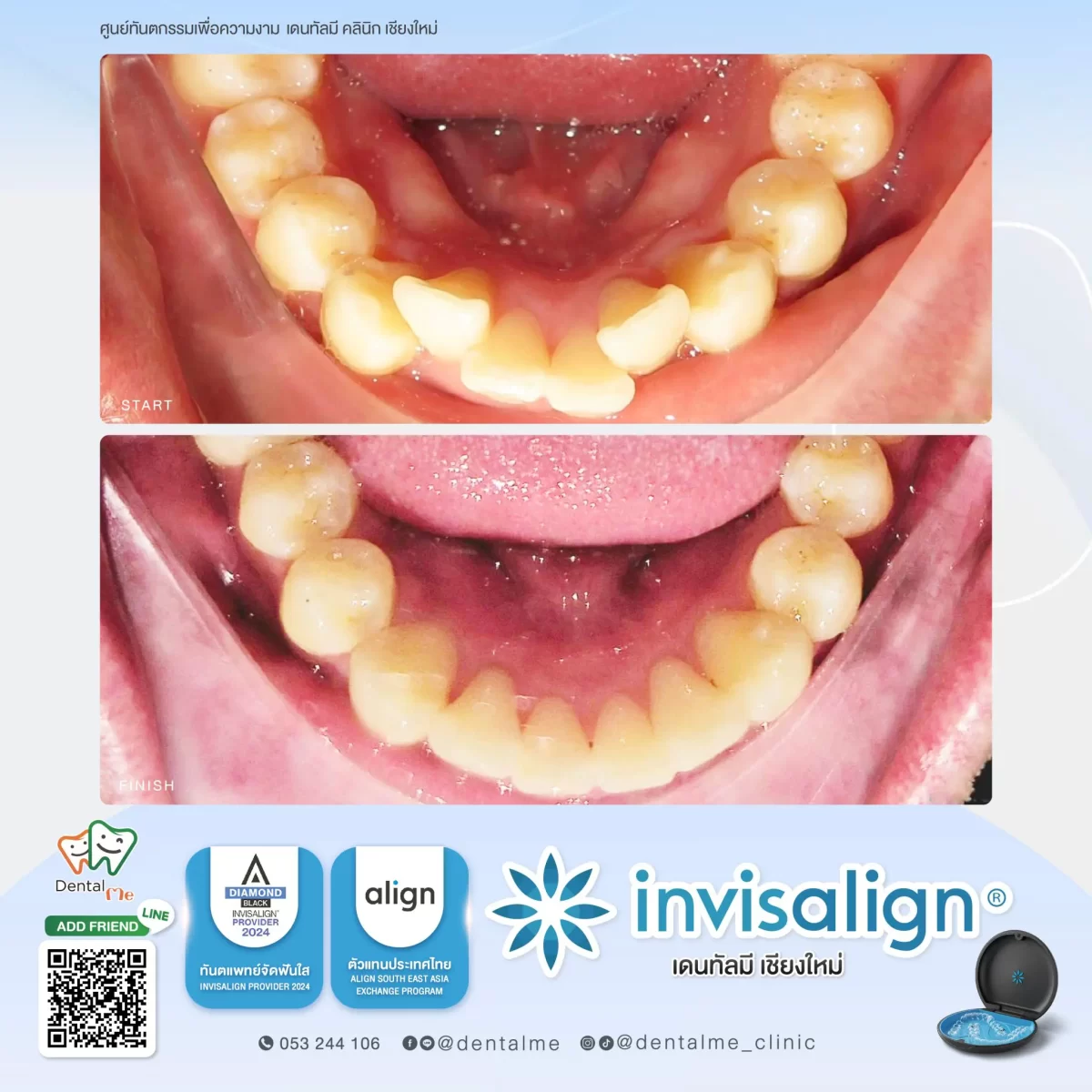 จัดฟันใส Invisalign เคสฟันล่างซ้อนเก ก่อนและหลังที่ Dentalme คลินิก เชียงใหม่