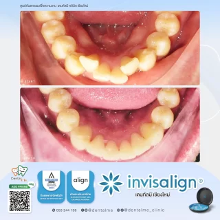 จัดฟันใส Invisalign เคสฟันล่างซ้อนเก ก่อนและหลังที่ Dentalme คลินิก เชียงใหม่