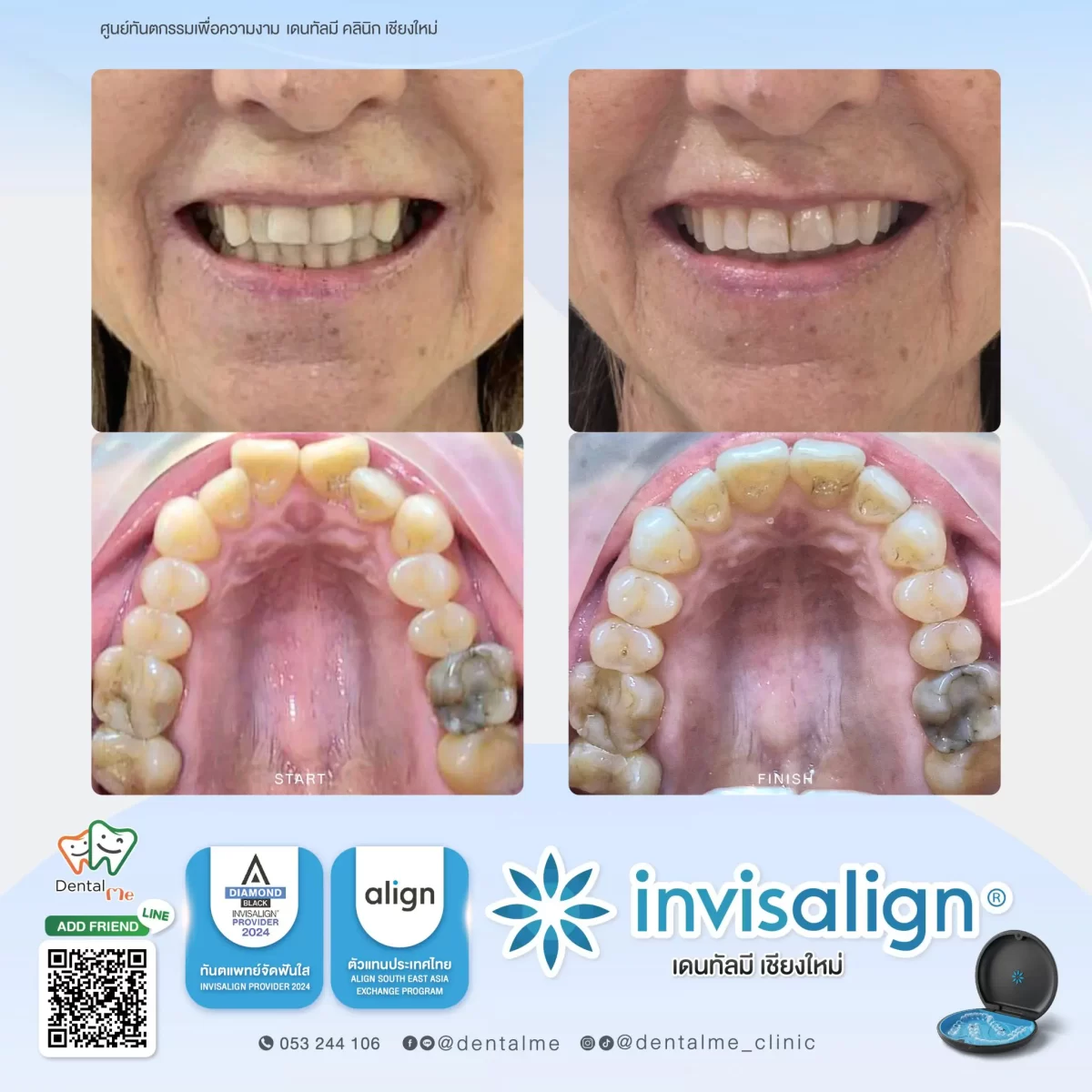 รีวิวจัดฟันใส Invisalign เคสผู้ใหญ่ ก่อนและหลังการรักษาที่ Dentalme คลินิก เชียงใหม่