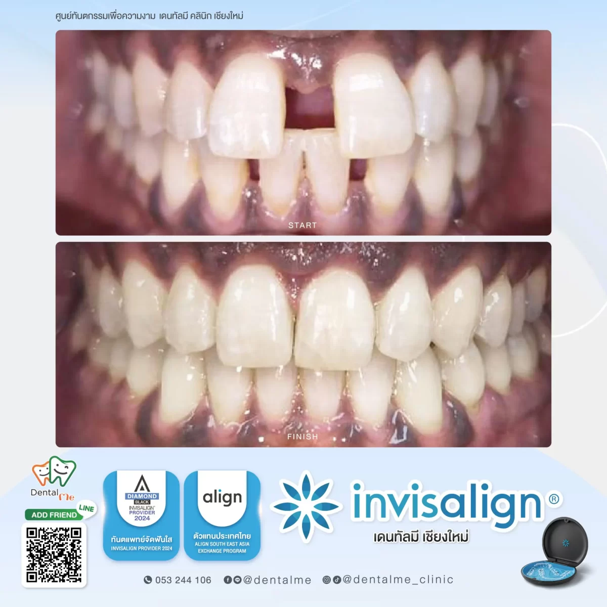 การจัดฟันใส Invisalign เคสฟันห่าง เปรียบเทียบก่อนและหลังที่ Dentalme คลินิก เชียงใหม่