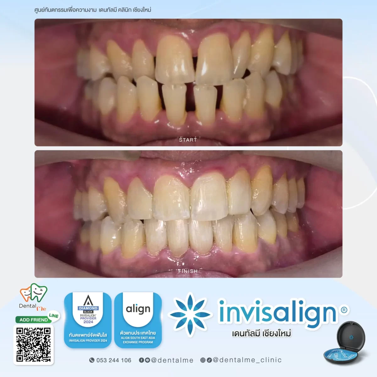 รีวิว Invisalign จัดฟันใส เคสฟันซ้อนเกและสบไม่พอดี ก่อนและหลัง ที่ Dentalme เชียงใหม่