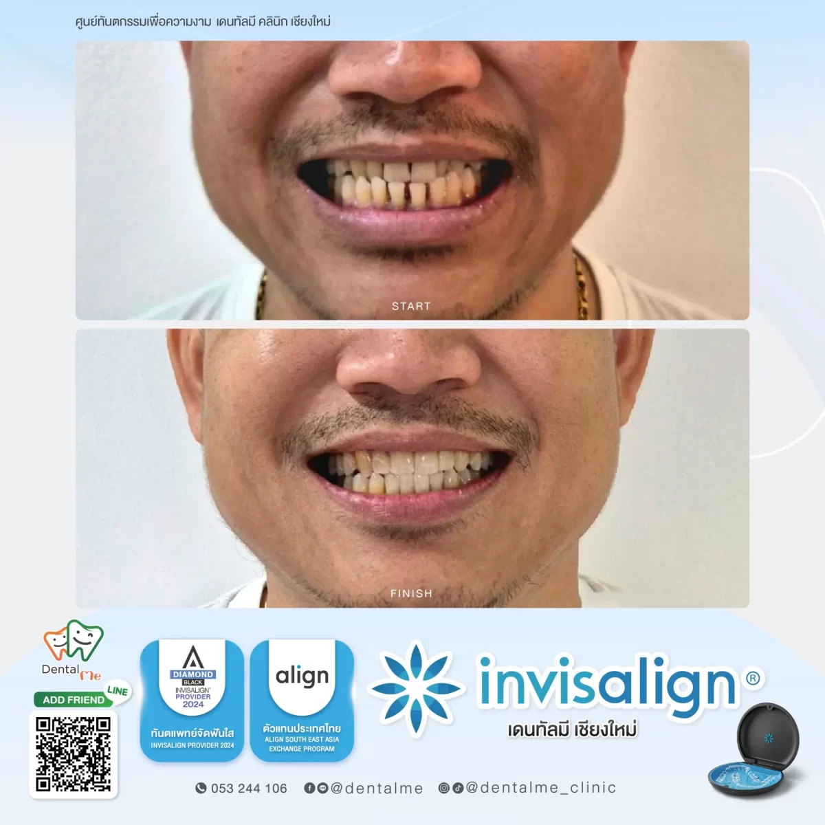 จัดฟันใส Invisalign เคสผู้ชาย รีวิวจริงที่ Dentalme คลินิก เชียงใหม่