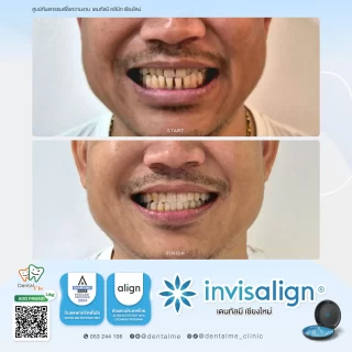 จัดฟันใส Invisalign เคสผู้ชาย รีวิวจริงที่ Dentalme คลินิก เชียงใหม่