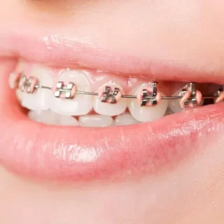 จัดฟัน เชียงใหม่ – Dentalme Clinic