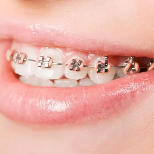 จัดฟัน เชียงใหม่ – Dentalme Clinic