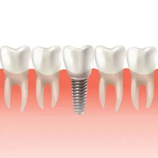 รากฟันเทียม เชียงใหม่ – Dentalme Clinic