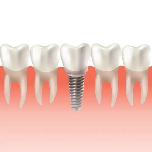 รากฟันเทียม เชียงใหม่ – Dentalme Clinic