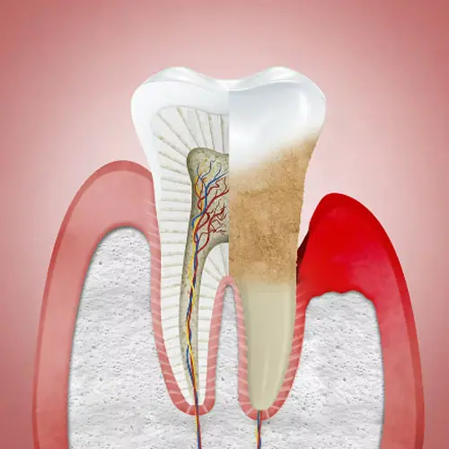 รักษาโรคเหงือก เหงือกอักเสบ – Dentalme Clinic เชียงใหม่