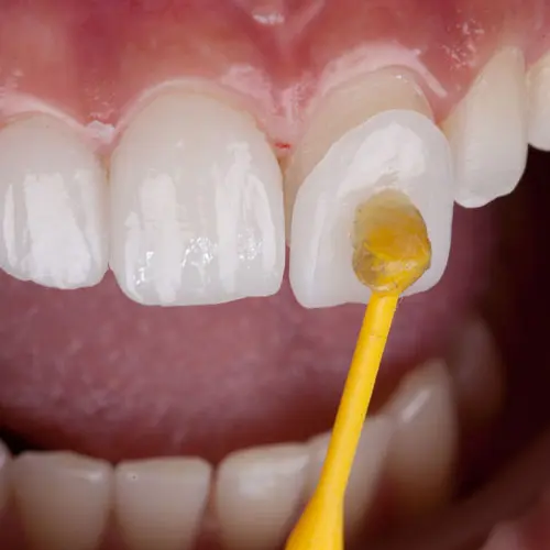 วีเนียร์พอร์ซเลน ปรับรอยยิ้ม – Dentalme Clinic เชียงใหม่