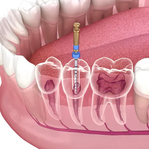 รักษารากฟัน – Dentalme Clinic เชียงใหม่