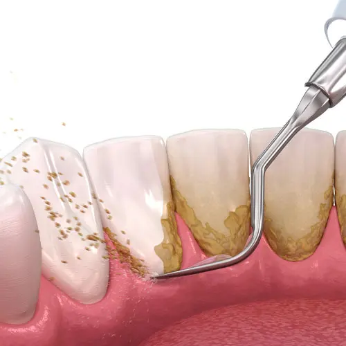 ขูดหินปูน ทำความสะอาดฟัน – Dentalme Clinic เชียงใหม่