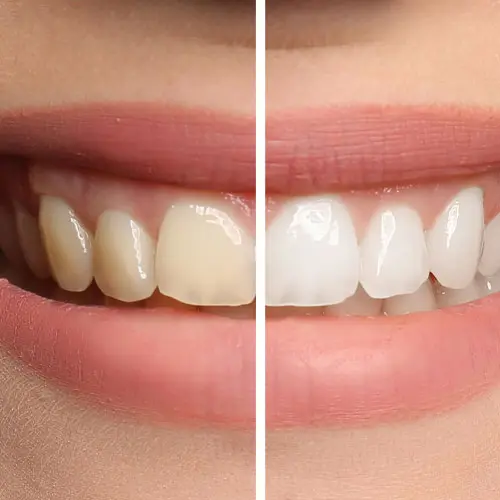 ฟอกสีฟัน เชียงใหม่ – Dentalme Clinic