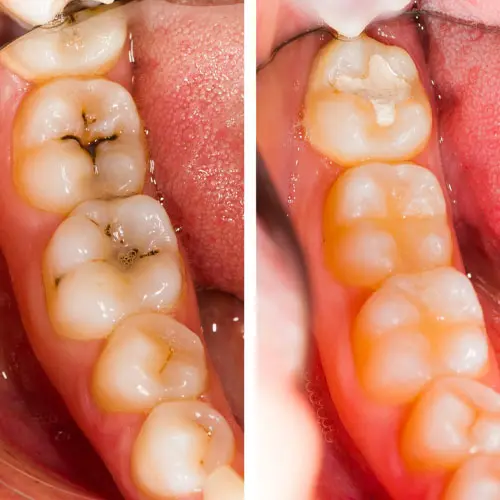 อุดฟัน รักษาฟันผุ – Dentalme Clinic เชียงใหม่