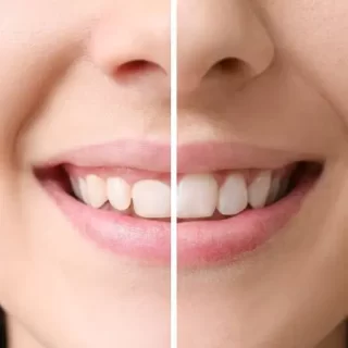 วีเนียร์ เชียงใหม่ – Dentalme Clinic